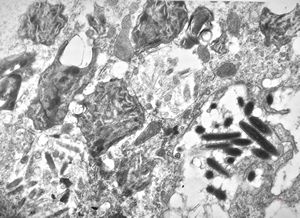 M,54y. | Whipple disease - duodenum M,54y. | Whipple disease - duodenum